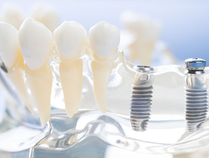 implants